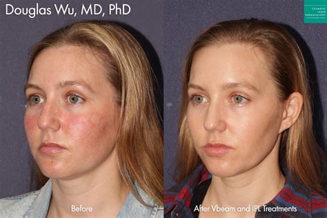 What To Expect Before During And After Ipl Photofacial Treatment