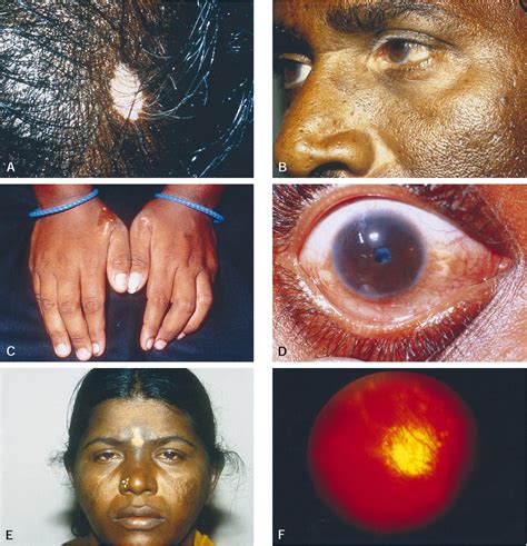 Vogt Koyanagi Harada Syndrome After Cutaneous Injury Ophthalmology