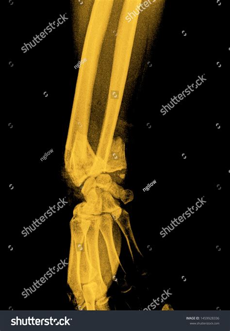 Wrist X Ray Anatomy Radiology Radiographic Stock Photo 1459928336