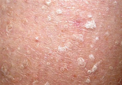 Seborrheic Keratosis Seborrheic Keratosis Cure Images And Photos Finder