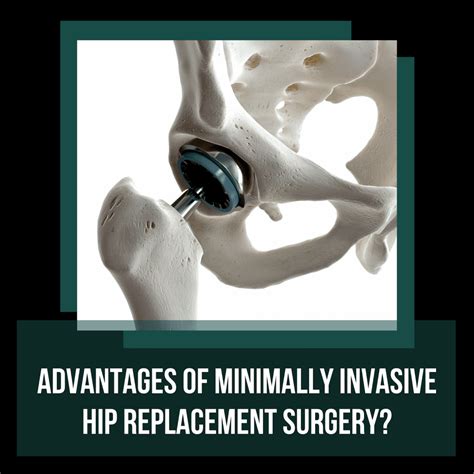 Advantages Of Minimally Invasive Hip Replacement Surgery Ashvin K Dewan Md