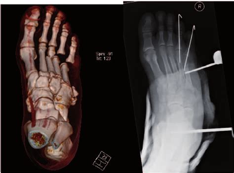 Complex Open Crush Injury To The Mid And Forefoot Managed With Initial