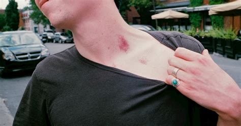 science explains how a hickey can kill you