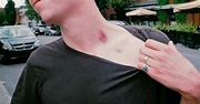 Science Explains How a Hickey Can Kill You