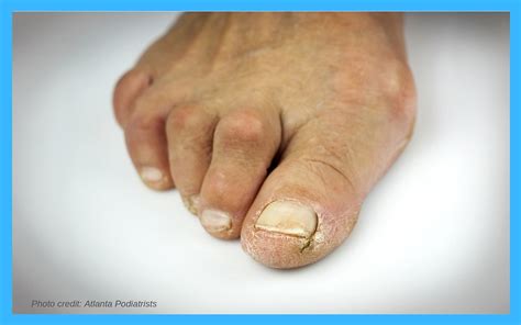 Hammertoe And Bunion Surgery Before And After
