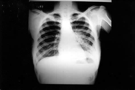 Chest X Ray Non Homogeneous Areas Of Alveolar Consolidation On The