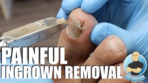 Treating An Extremely Painful Ingrown Toenail With How To Advice