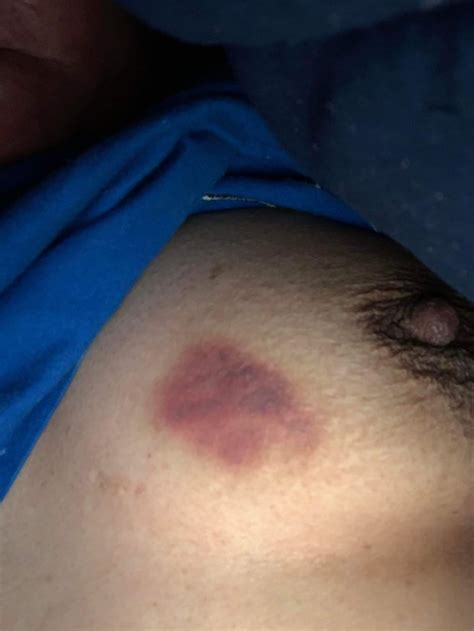 Gave My Girlfriend A Hickey On Her Tit She Kept Screener20