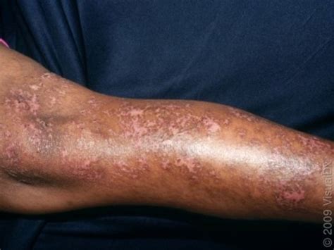 A Year Old With Diabetes And Discoloration Of The Skin Journal Of Urgent Care Medicine