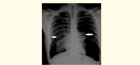Postero Lateral View Of Chest X Ray Bilateral Primary Spontaneous Download Scientific Diagram