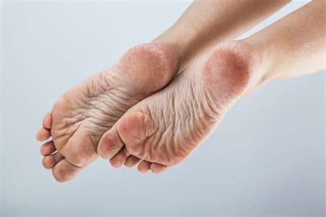 Foot Health Calluses Verrucas Blisters Etc At Walk This Why Podiatry