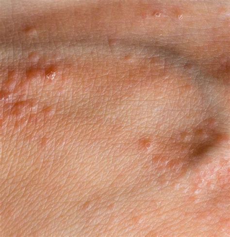Pimple On The Hand Causes And Treatment