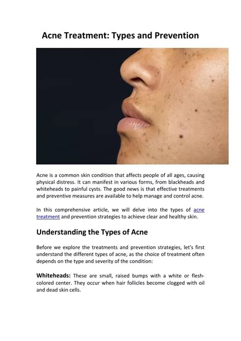 Ppt Acne Treatment Types And Prevention Powerpoint Presentation