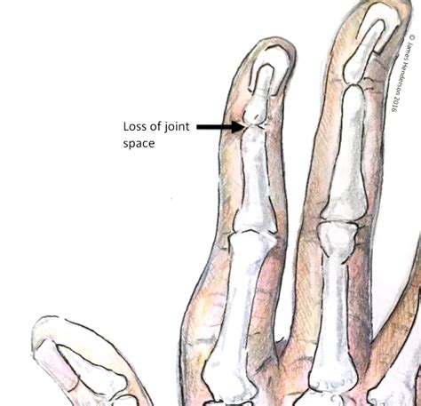 Finger Joint Arthritis James Henderson Specialist Plastic And Hand