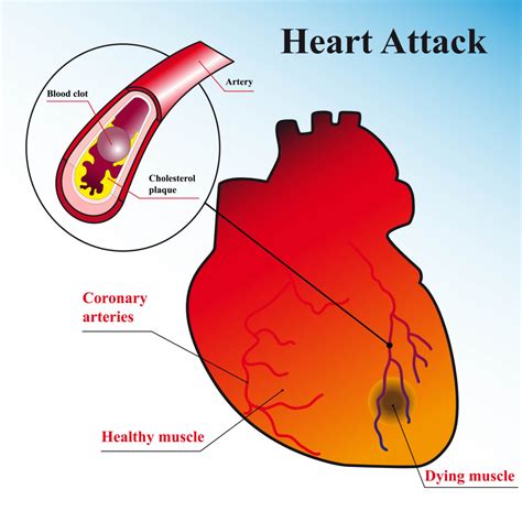 What Is A Heart Attack Article By Dr Vivek Baliga Internal Medicine