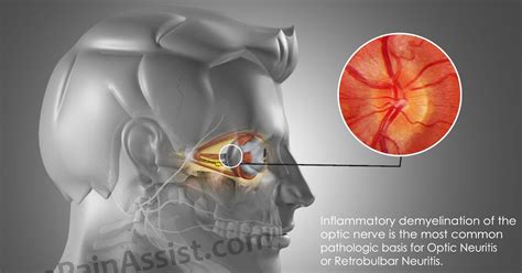 Reasons Of Sinusitis And Sinusitis Eye Pain Tondahtyuimcfall