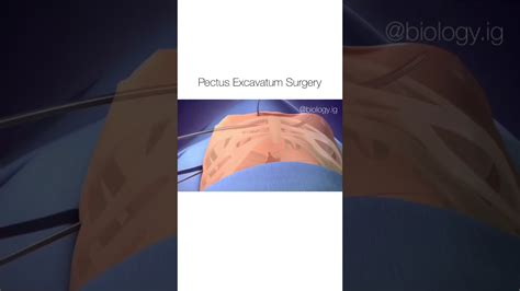 Pectus Excavatum Surgery Youtube