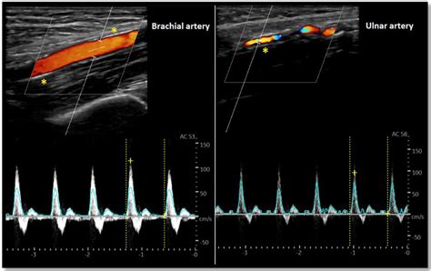 Doppler Mode Arterial Evaluation Brachial Left And Ulnar Right