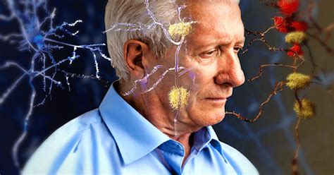 6 Síntomas De Alzheimer En Su Primera Etapa A Los Que Se Le Debe