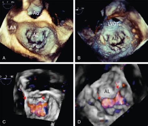 Imaging Guidance Of Transcatheter Mitral Valve Procedures Clinical Tree