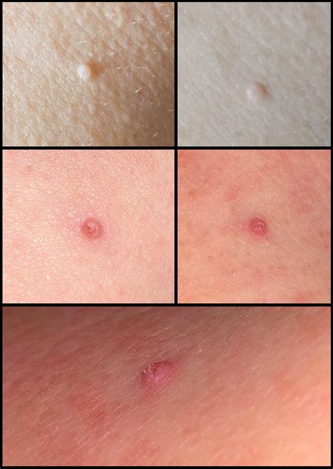 Itchy Red Bumps On Skin Images And Photos Finder