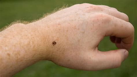 Tick Bites Symptoms And Treatments