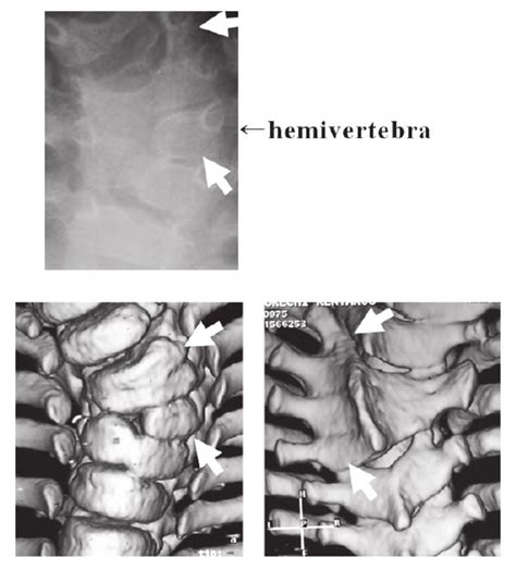 Congenital Scoliosis Of A Hemivertebra With Posterior Fusion A