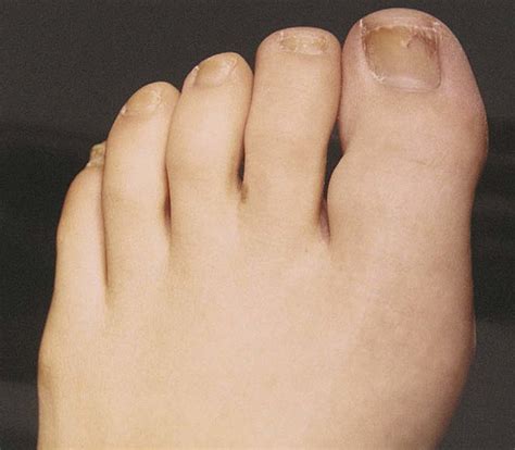 Clinical Image Of The Painful Left Great Toe With A Slowly Enlarging