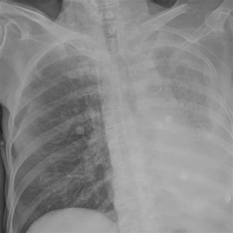 Chest Radiography Showed Abnormal Elevation Of The Left Hemidiaphragm