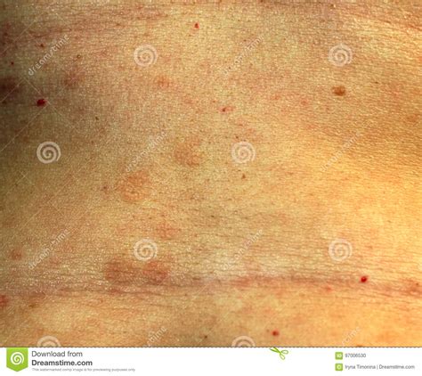 Red Flat Lichen Planus Red Spots On The Skin Of The Abdomen Stock