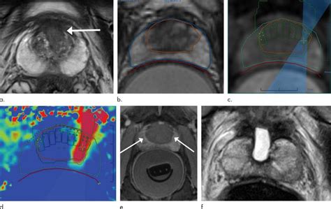 High Intensity Focused Ultrasound Treats Prostate Cancer With Minimal