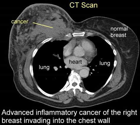 Breast Cancer Chest Wall Invasion Rational Science