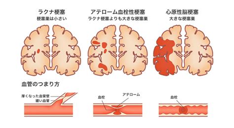 Doujin music | 同人音楽 8 янв 2015 в 18:38. 脳梗塞の前兆・原因・症状について!なぜ多くの人が脳梗塞の ...