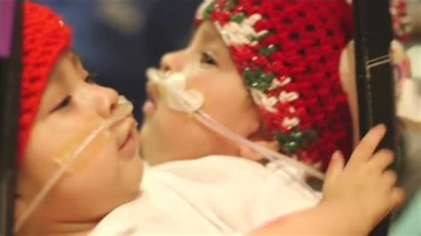 Conjoined Twins Preparing For Separation Latest News Videos Fox News