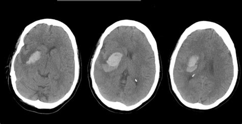 Basal Ganglia Ct Scan