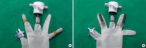 Homemade Port System Of Single Incision Laparoscopic Surgery For