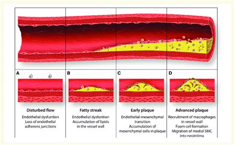 Potential Contribution Of Endmt To Atherosclerosis Progression At