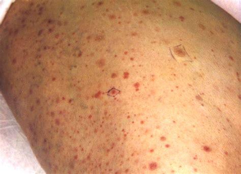Petechial Rash On The Extremities The Bmj