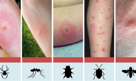 Discover How To Identify The 8 Most Common Insect Bites Healthy Food