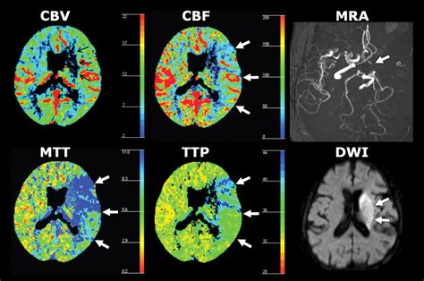 Perfusion Ct Of The Brain Using 40 Mm Wide Detector And Toggling Table