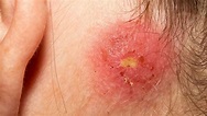 staph infection on skin: Causes and prevention in 2021