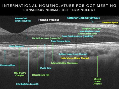 The Official Oct Interpretation Optical Coherence Tomography