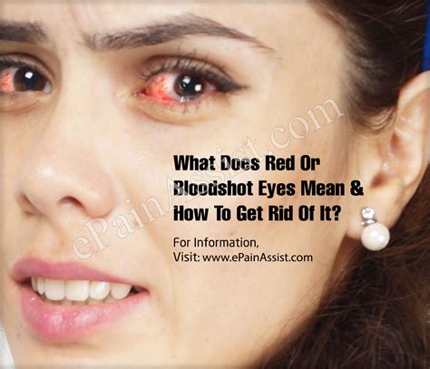 What Does Red Or Bloodshot Eyes Mean And How To Get Rid Of It