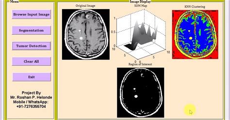 Matlab Code For Brain Tumor Detection Using Segmentation And Clustering