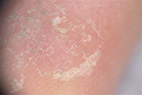 Acral Skin Eruption Observed During Sars‐cov‐2 Pandemic Possible
