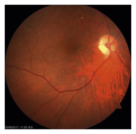 Fundus Photograph Of The Right A And Left B Eyes The Right Eye