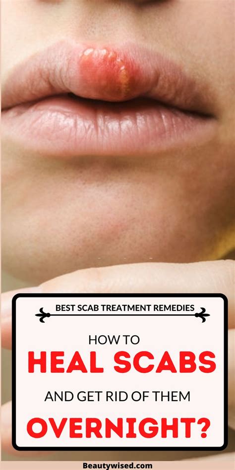 How To Get Rid Of Scabs On Your Scalp On The Face Or On Your Body