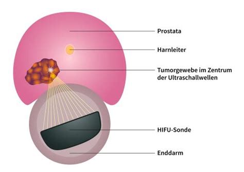 Bild Weniger Ist Oft Mehr Klinik Für Prostata Therapie Heidelberg