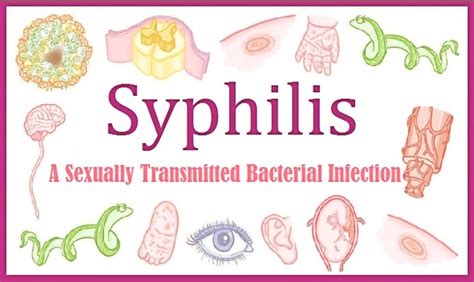 Syphilis A Sexually Transmitted Bacterial Infection Types And Stages