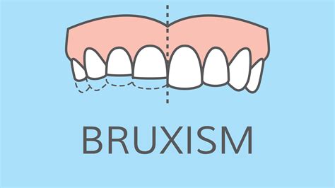 What Is Bruxism Enlighten Smiles Blog